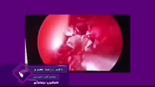 در مورد عوارض پولیپ بینی چه می دانید؟؟