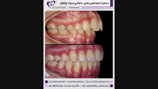 درمان ارتودنسی فکی - دندانی و یک چالش | دکتر فاضل فیروزی