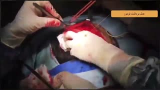 فیلم توده شقیقه