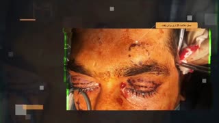 لیفت اندوسکوپی و برداشتن تومور پیشانی