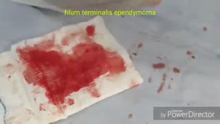 تومور اپاندیموما فیلوم یا انتهای نخاع