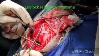 فیلم عمل تومور مغزی بزرگ در خانم جوان