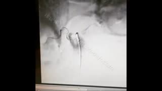 آنژیوگرافی نخاعی