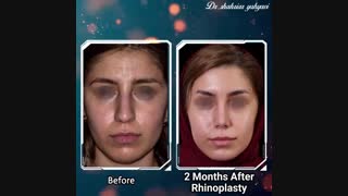 دو ماه بعد از جراحی زیبایی بینی