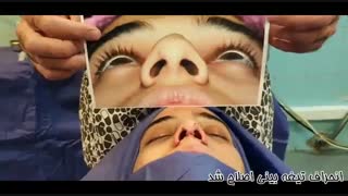 فیلم عمل بینی استخوانی