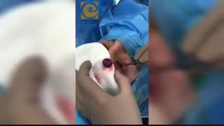 فیلم خارج کردن توده بزرگ اربیت چشم