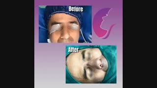 فیلم واقعی عمل بینی با انحراف زیاد کاشت ریش