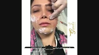 فرم دهی گونه با تزریق ژل