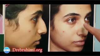 عمل بینی استخوانی قوزدار توسط دکتر امید ابراهیمی بهترین جراح بینی