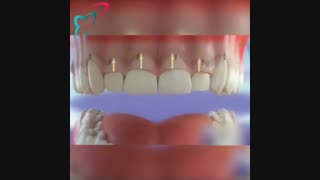 چگونه طول تاج دندان را افزایش میدهیم