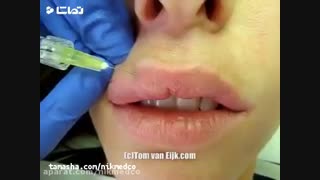 آموزش تزریق ژل لب با سوزن