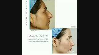 نمونه جراحی بینی استخوانی