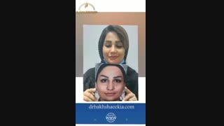 نمونه عمل بینی گوشتی نیمه فانتزی