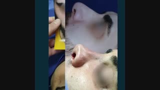 نمونه عمل بینی مردانه