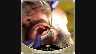 برای اولین بار، استفاده از پست های رشته ای در ایران | دکتر لیلا عطایی