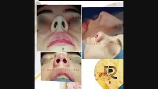 فیلم جراحی بینی در حین عمل