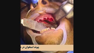 فیلم واقعی عمل خارج کردن دندان ها