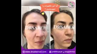 تزریق فیلر در گونه و خط خنده و اطراف لب