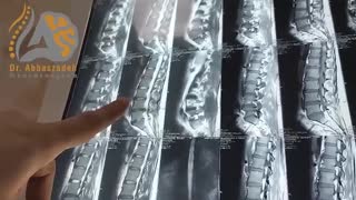 فیلم واقعی جراحى دیسک کمر در خانم 35 ساله