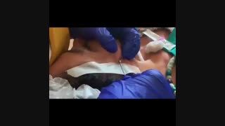 فیلم لیفتینگ صورت با نخ