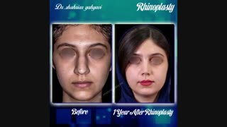 نمونه کار جراحی بینی