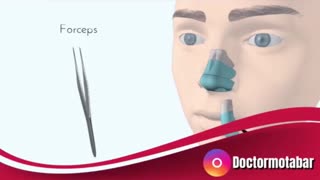 عمل برداشتن  قوز بینی