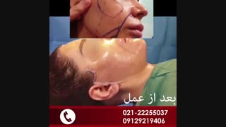 لیفت و جوانسازی صورت جراحی زیبایی پلک