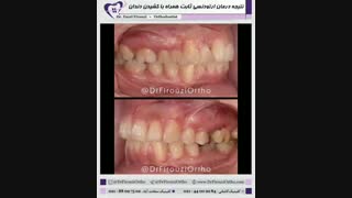نتیجه درمان ارتودنسی ثابت همراه با کشیدن دندان | دکتر فاضل فیروزی