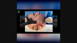 جراحی بینی اولیه با پروجکشن نسبتا زیاد | دکتر باستانی نژاد
