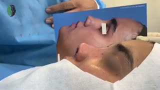 جراحی بینی زینی شکل توسط دکتر باستانی نژاد | جراح بینی تهران