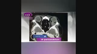 فیلم جراحی بیرون زدگی چشم چپ به دلیل تومور اربیت