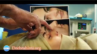 عمل بینی قوزدار توسط دکتر امید ابراهیمی بهترین جراح بینی در تهران