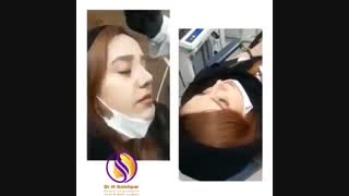 یک هفته پس از جراحی بینی