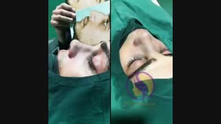 عمل بینی مردانه