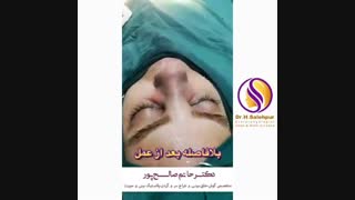 نتیجه بعد از عمل بینی