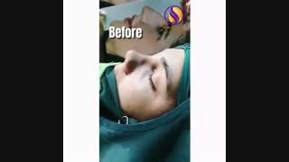 رینوپلاستی