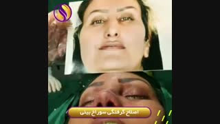 اصلاح گرفتگی سوراخ بینی