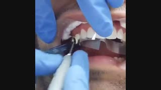 کامپوزیت دندان-مرکز فوق تخصصی ایمپلنت و زیبایی دندان پردیس