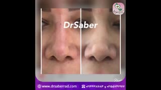 تزریق فیلر بینی
