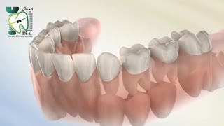 چه زمانی نیاز به استفاده از فضا نگهدار است؟ | کلینیک دندانپزشکی ایده آل