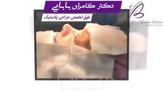 فیلم واقعی بلافاصله بعد از عمل بینی