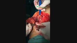 جراحی تومور پلی ویلندولار ندولار سینویت زانو (PVNS)