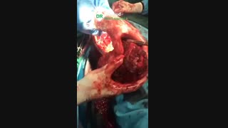 فیلم واقعی جراحی خارج سازی تومور مهاجم و وسیع بازو