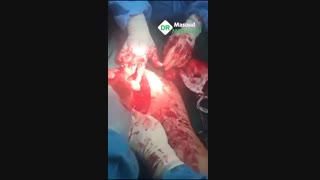 فیلم عمل خارج سازی لیپوسارکوم وسیع ناحیه لگن و ران