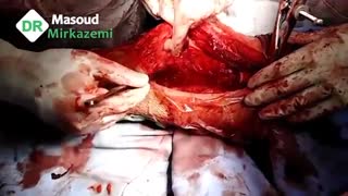 عمل جراحی پروتز زانو و رزکسیون کامل تومور استئوسارکوم