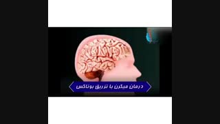 تزریق بوتاکس روشی مناسب برای درمان میگرن