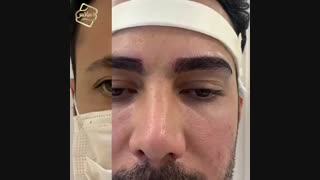 کاشت مو کلینیک تخصصی رنسانس رفع افتادگی پلک