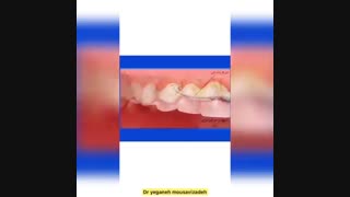 خونریزی لثه،هنگام مسواک زدن