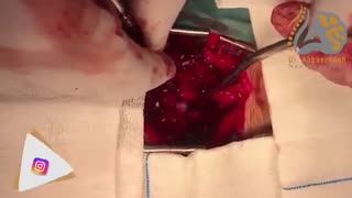 فیلم جراحی دیسک و تنگی کانال نخاعی کمر