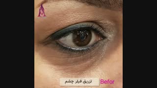 فیلم قبل و بعد تزریق فیلر زیر چشم